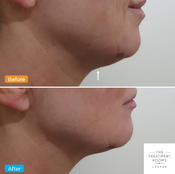 Jowl and chin lift